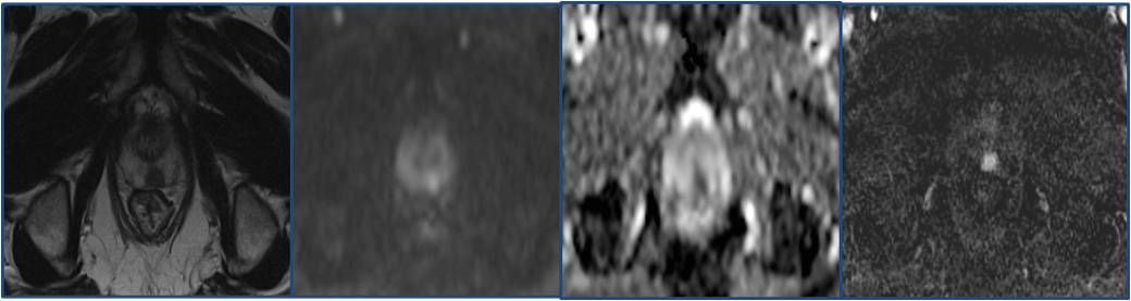 RM Multiparametrica della prostata