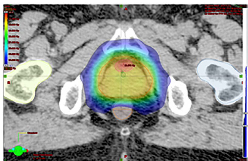 radioterapia prostata in 5 sedute