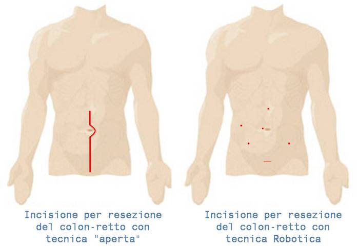 resezione robotica colonretto