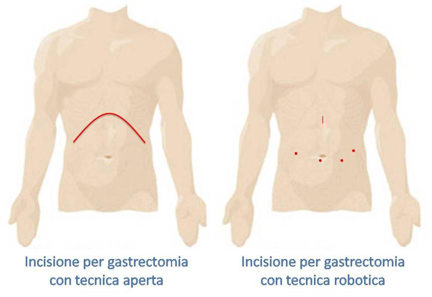chirurgia gastrica